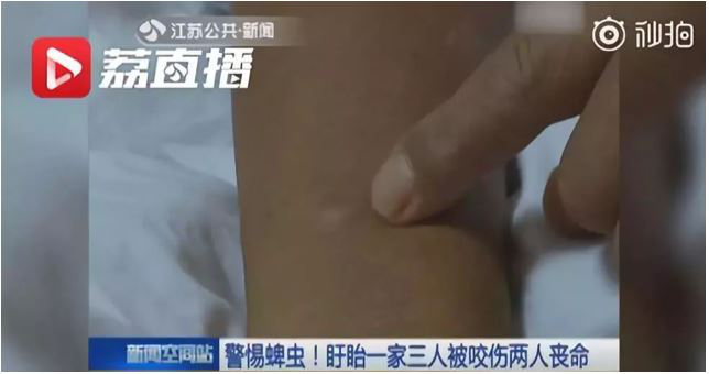 中山市民注意蜱蟲叮咬！請做好這些預(yù)防措施